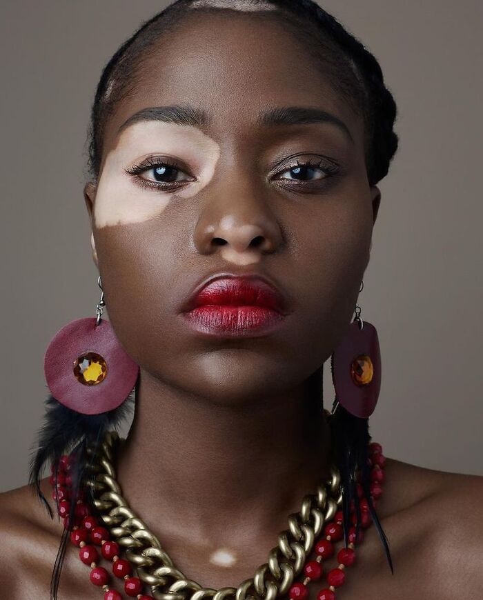 Wait, They Actually Made Vitiligo Look This Cool? 35 Pics That’ll Blow Your Mind