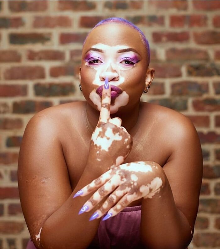 Wait, They Actually Made Vitiligo Look This Cool? 35 Pics That’ll Blow Your Mind