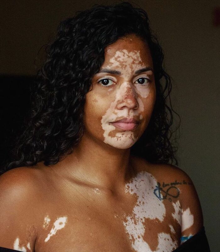 Wait, They Actually Made Vitiligo Look This Cool? 35 Pics That’ll Blow Your Mind