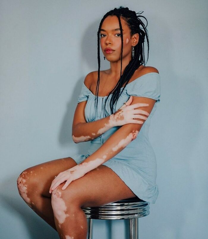Wait, They Actually Made Vitiligo Look This Cool? 35 Pics That’ll Blow Your Mind