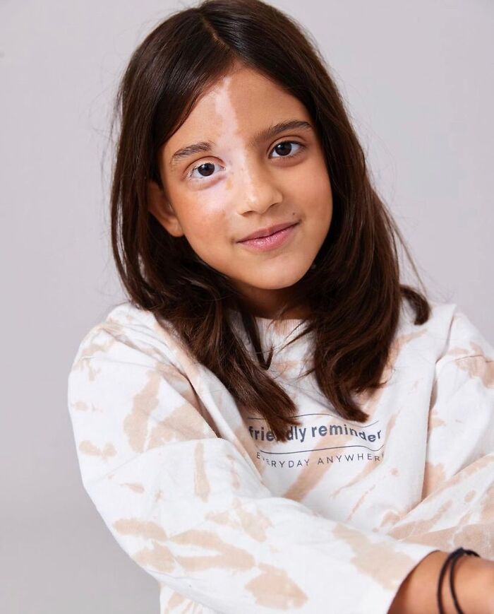 Wait, They Actually Made Vitiligo Look This Cool? 35 Pics That’ll Blow Your Mind