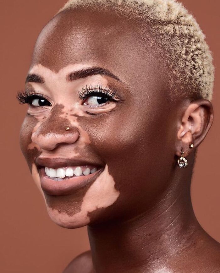 Wait, They Actually Made Vitiligo Look This Cool? 35 Pics That’ll Blow Your Mind