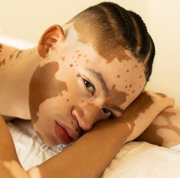 Wait, They Actually Made Vitiligo Look This Cool? 35 Pics That’ll Blow Your Mind