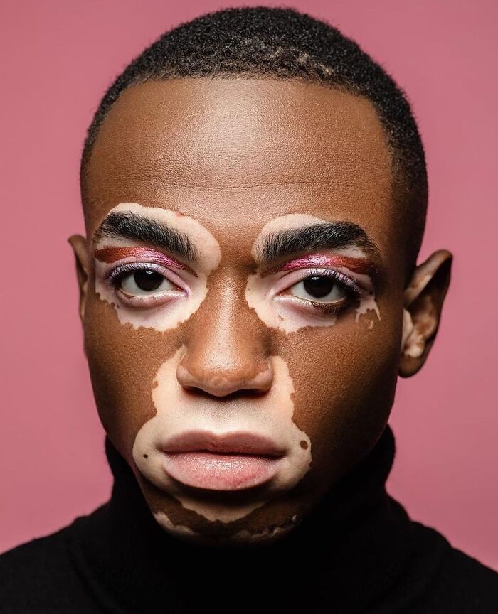 Wait, They Actually Made Vitiligo Look This Cool? 35 Pics That’ll Blow Your Mind