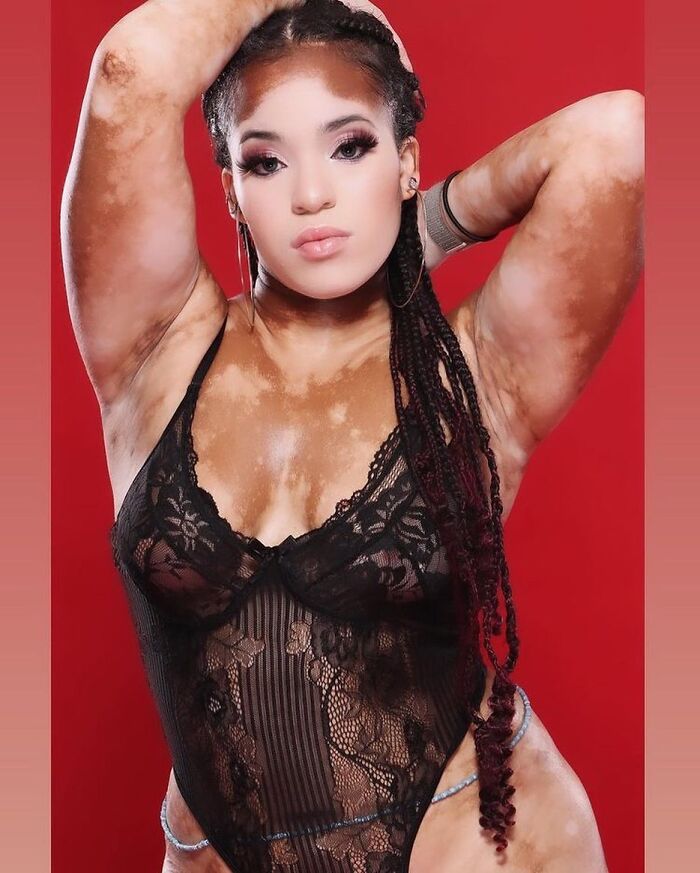 Wait, They Actually Made Vitiligo Look This Cool? 35 Pics That’ll Blow Your Mind