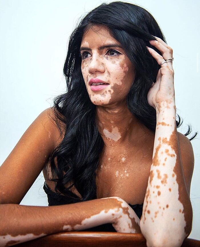 Wait, They Actually Made Vitiligo Look This Cool? 35 Pics That’ll Blow Your Mind