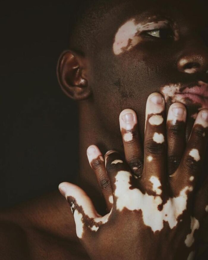 Wait, They Actually Made Vitiligo Look This Cool? 35 Pics That’ll Blow Your Mind