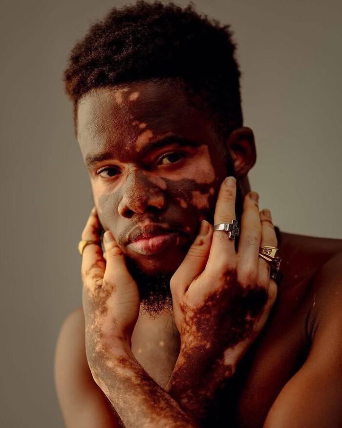 Wait, They Actually Made Vitiligo Look This Cool? 35 Pics That’ll Blow Your Mind