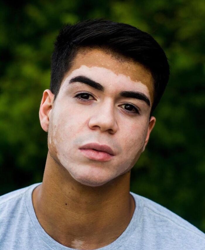 Wait, They Actually Made Vitiligo Look This Cool? 35 Pics That’ll Blow Your Mind