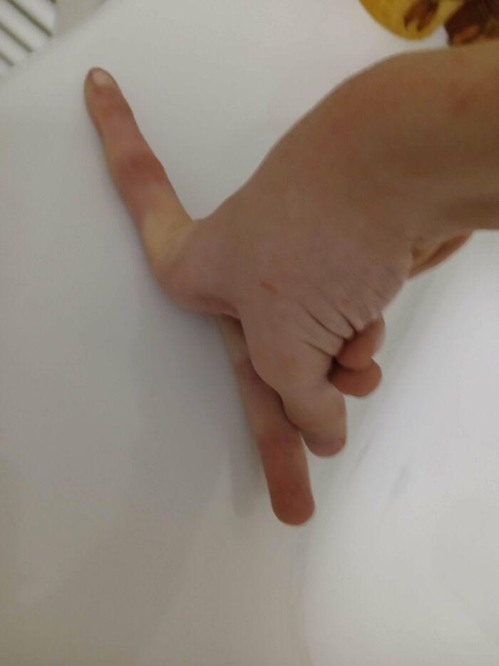 Got Finger Weirdness? Same Here!