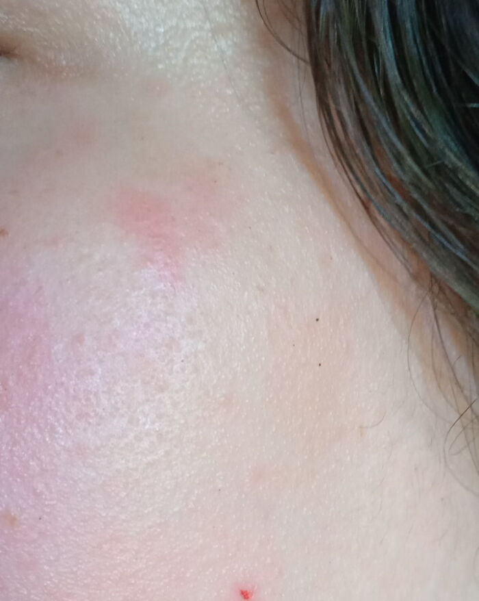 Why Do These Marks Show Up On My Face When I Cry? Anyone Know?