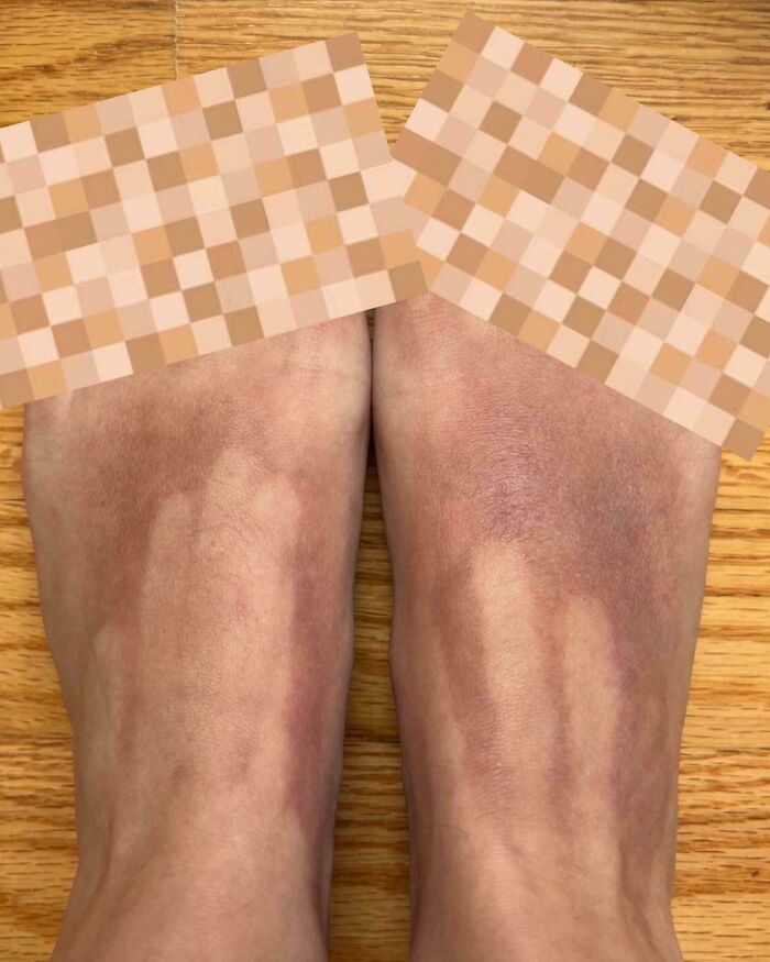 Forgot To Cover My Feet Completely With Sunscreen—Got Nasty Burn and Tan Lines That Match My Fingers Perfectly