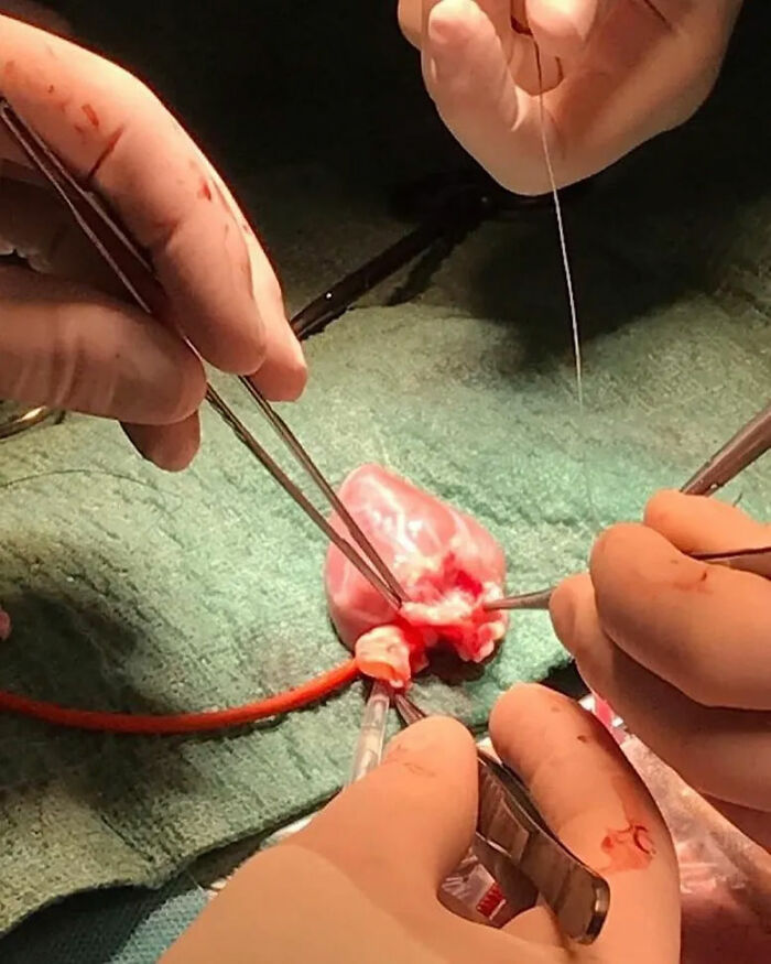 Little Heart, Big Miracle: Pediatric Heart Transplant