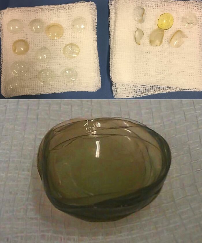 Surgeon Found 27 Contact Lenses Hiding in a Woman's Eye—Yes, Really!