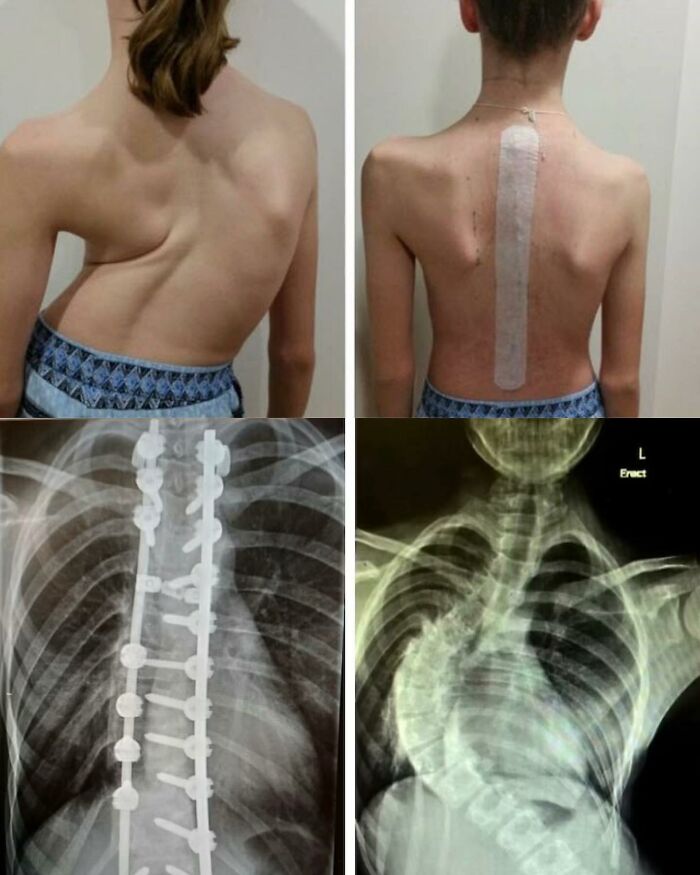 From Curveball to Comeback: Scoliosis Surgery That Rocks!