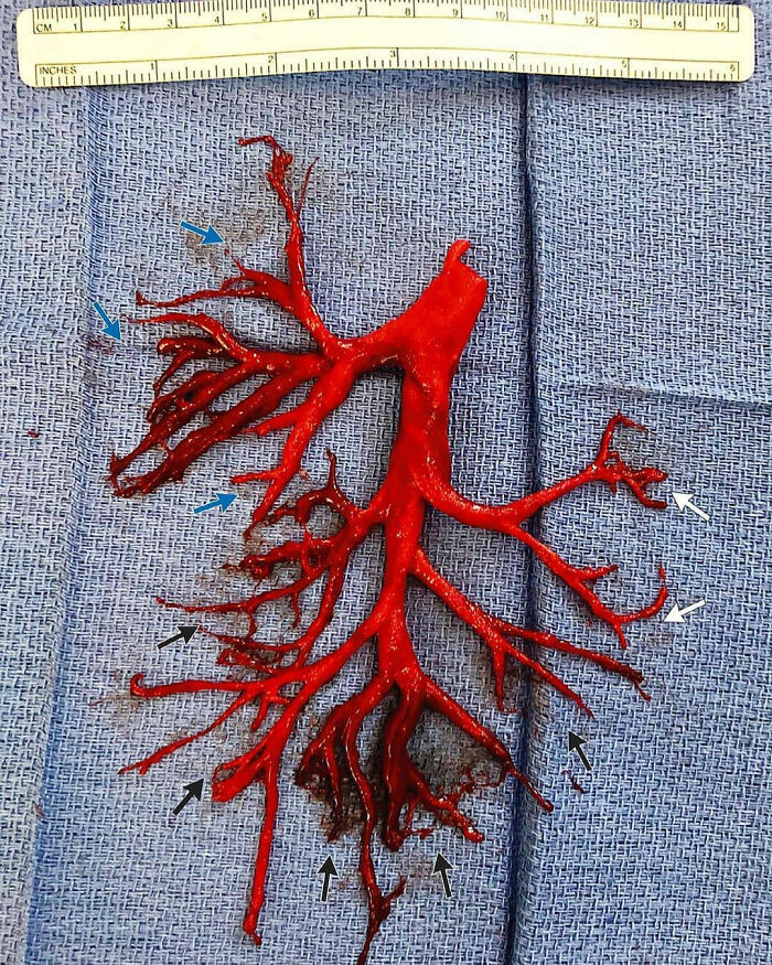 Blood Clot That Looked Exactly Like Lung Airways—Crazy!
