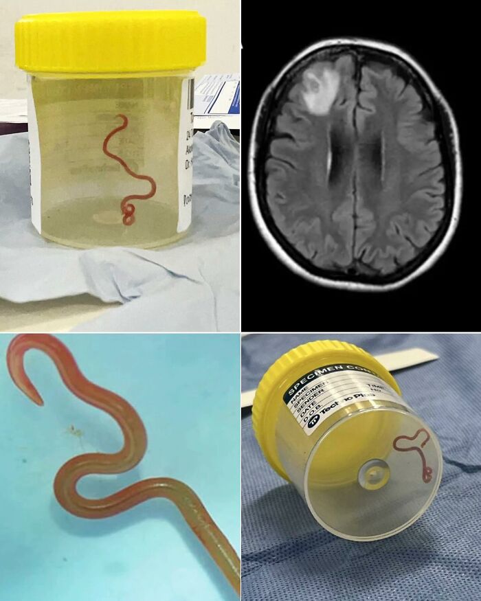 Doctor Pulls Live 3-Inch Worm From Woman’s Brain—Not a Horror Movie