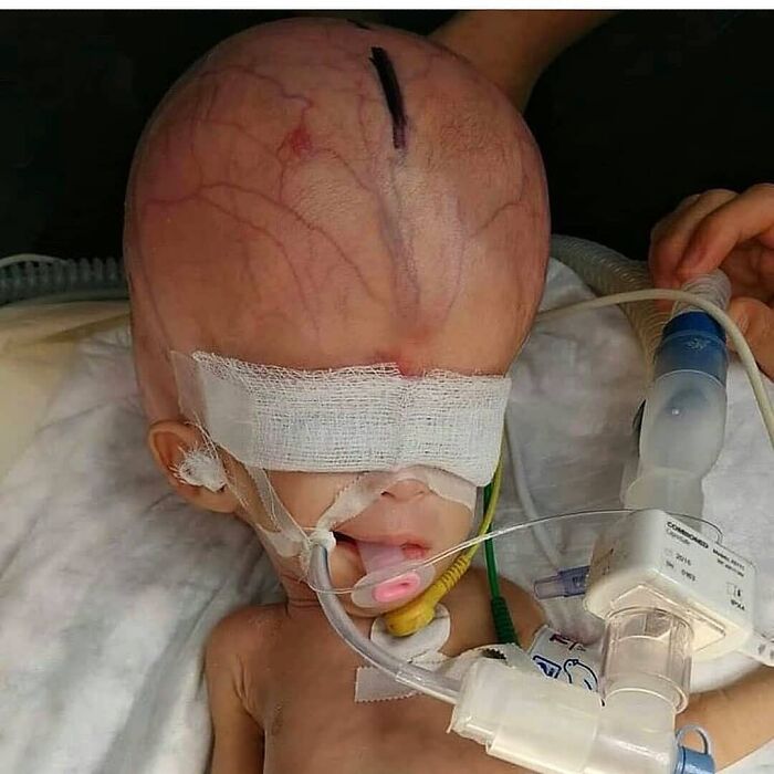 Hydrocephalus in Turbo Mode: The Huge Head of a Baby