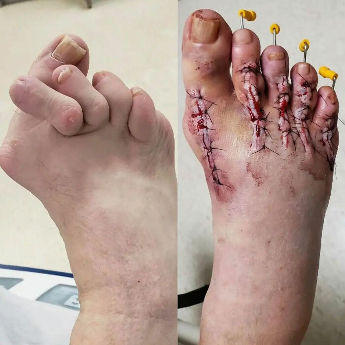 Surgery Perfects a Toe Makeover After Arthritis Went Wild