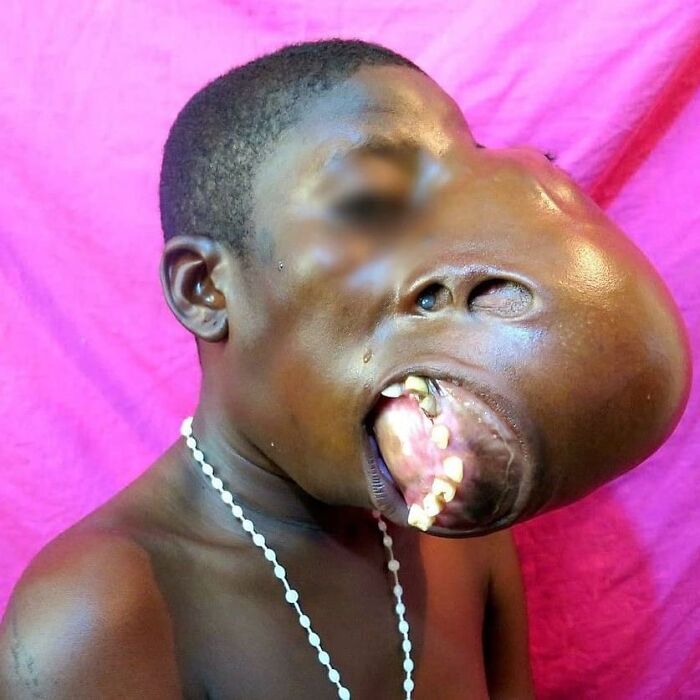 When Bones Go Wobbly: Craniofacial Fibrous Dysplasia Case