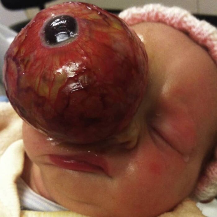 Giant Orbital Tumor in Newborn? They Fixed It Fast!
