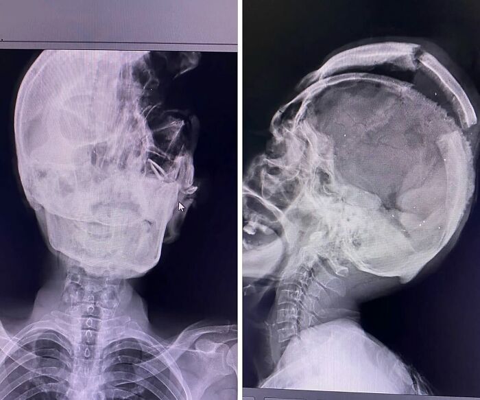 AK-47 Bullet Left Skull in Pieces—View the X-Rays