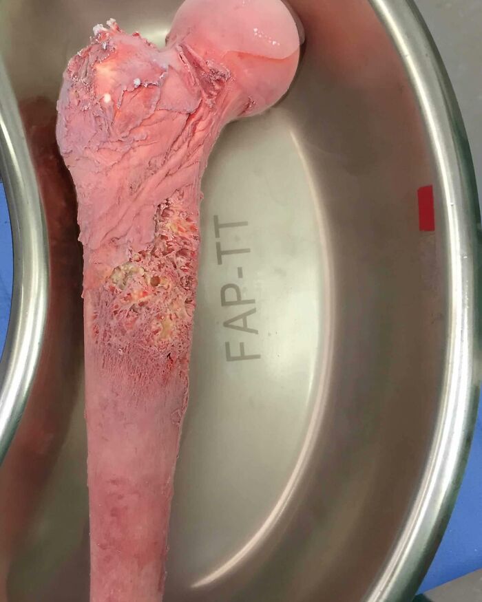 Frozen to Death: Using Liquid Nitrogen to Treat Bone Cancer