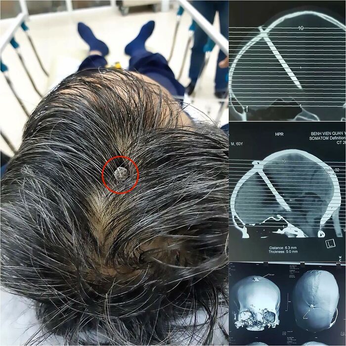 Man Walks Into Hospital with HUGE Nail in Skull—But No Clue How It Got There!