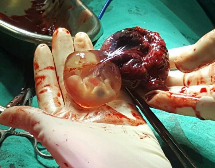 Ovarian Ectopic Pregnancy: When a Fertilized Egg Goes Rogue