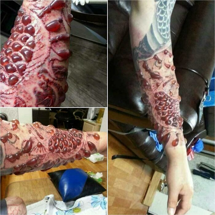 Tattoo Removal Disaster: Blisters Packed with Ink!