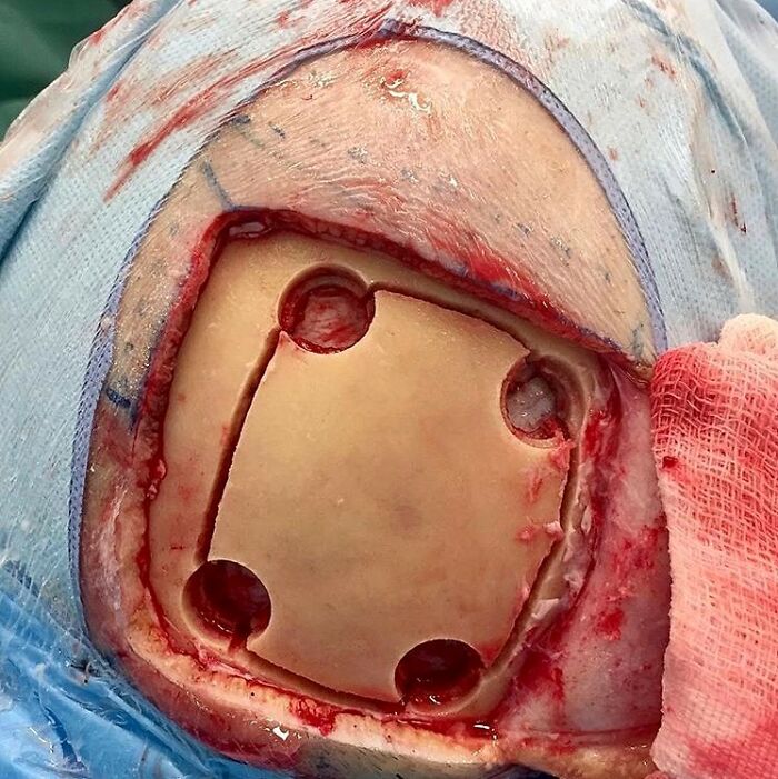 Putting a Skull Back Together Like a Puzzle