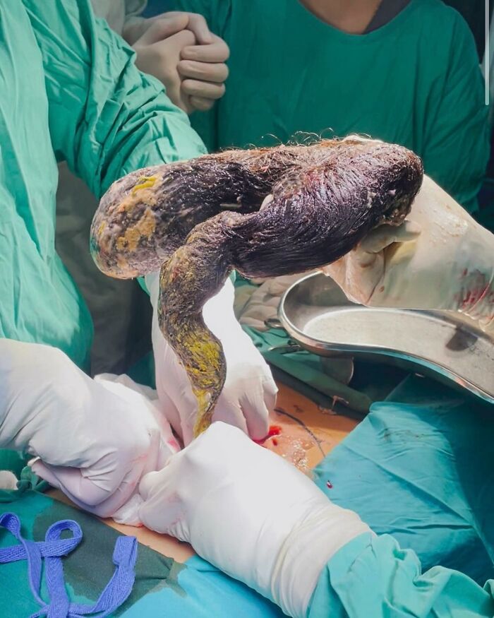 Hairball Alert! Giant Hairball in Stomach Removed