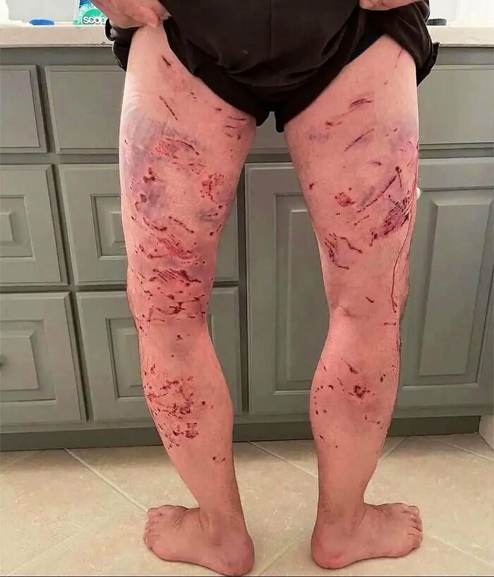 Dog Bites Can Be Nasty—and Deadly Worldwide