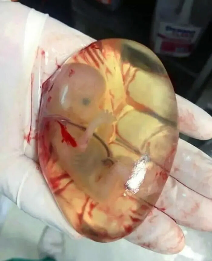 Baby Still Inside Its Amniotic Membrane: The Ultimate Water Balloon