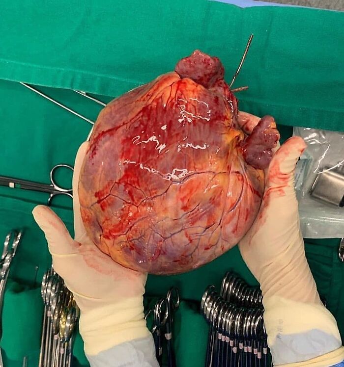 Heart So Big It’s Like a Soft Globe—A Mega-Sized Marvel