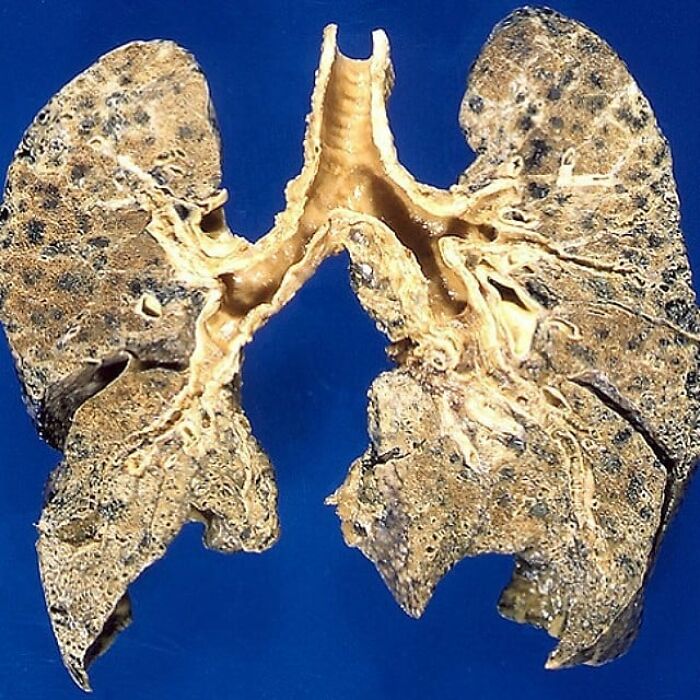 Lungs After COPD: The Tough Life of Breathing