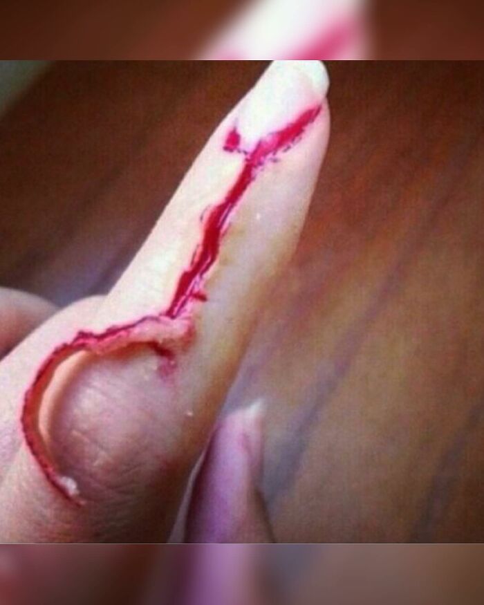 This Hangnail Went Full Extreme Mode