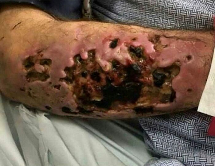 Krokodil Skin Necrosis: When Drugs Attack Your Flesh