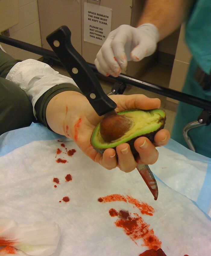 Avocado Injuries on the Rise: The Kitchen’s New Danger