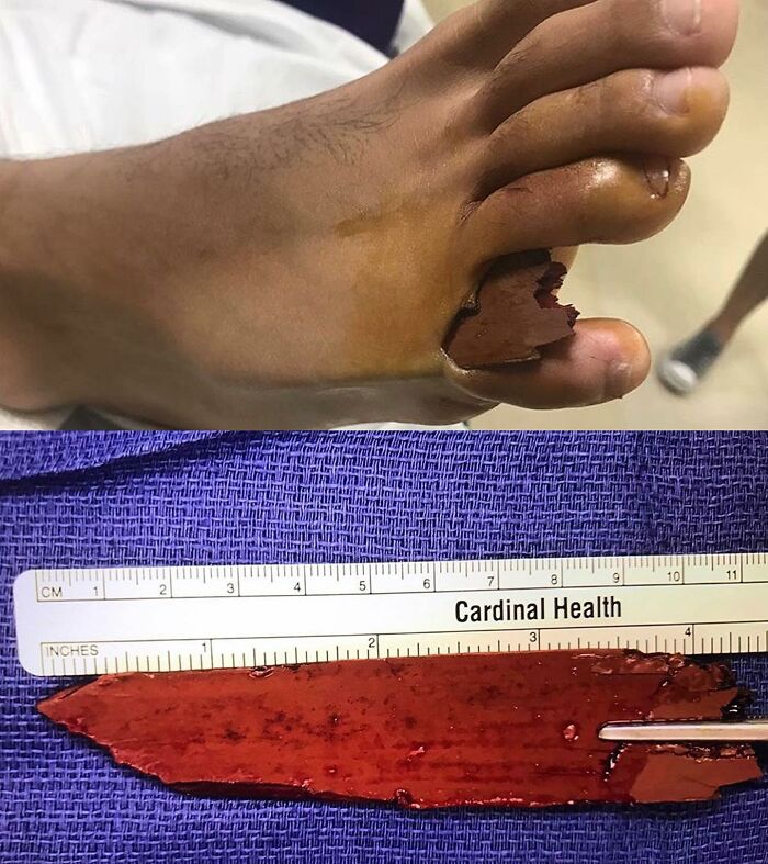 Wood Splinter Surprise: A 15-Year-Old’s Foot Story