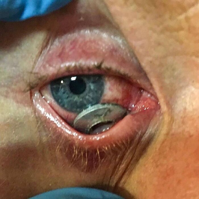 Metal Washer in Eye: A Work Accident Gone Weird