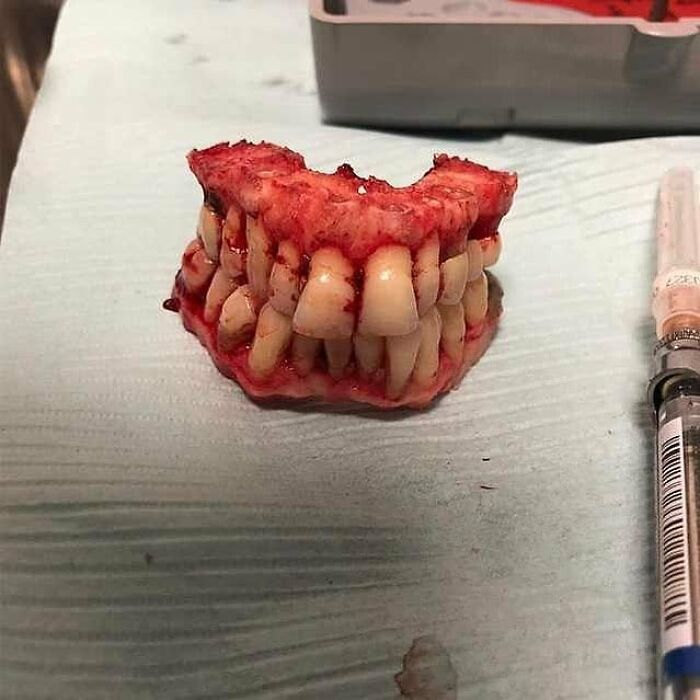 All Teeth Gone! Jaw Bone Surgery for Full-Mouth Implants