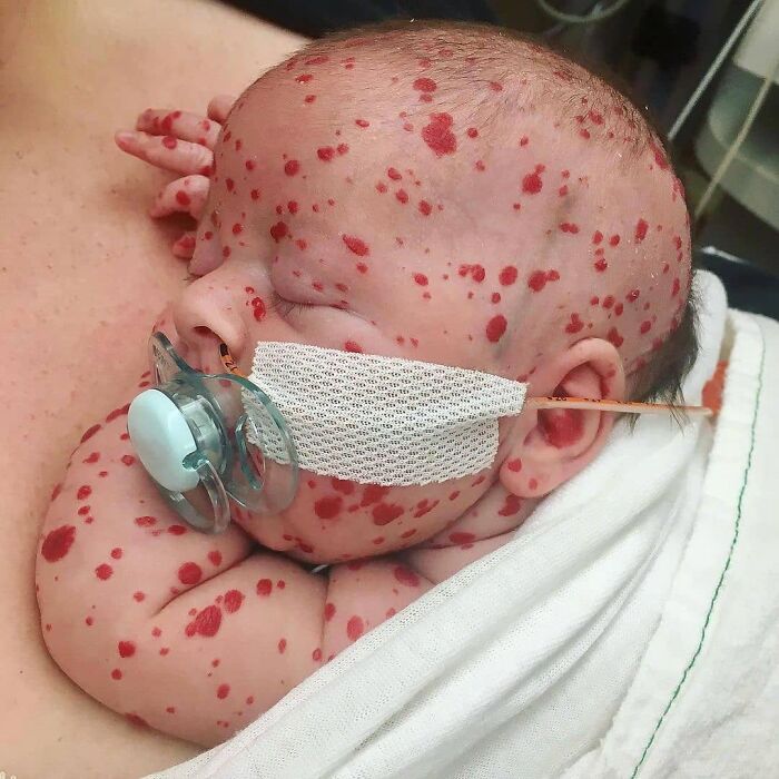 Baby with Skin Bumps: Multiple Infantile Hemangiomas Explained