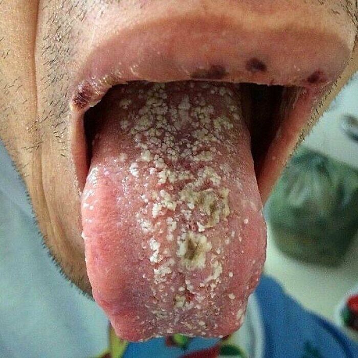 Oral Thrush: The Fungal Party in the Mouth