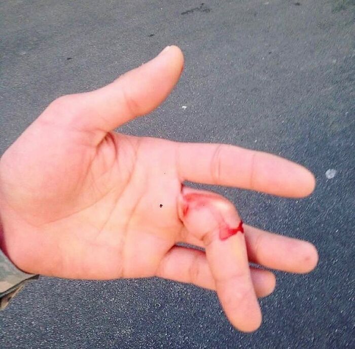 Finger Gets Bent the Wrong Way and Dislocates