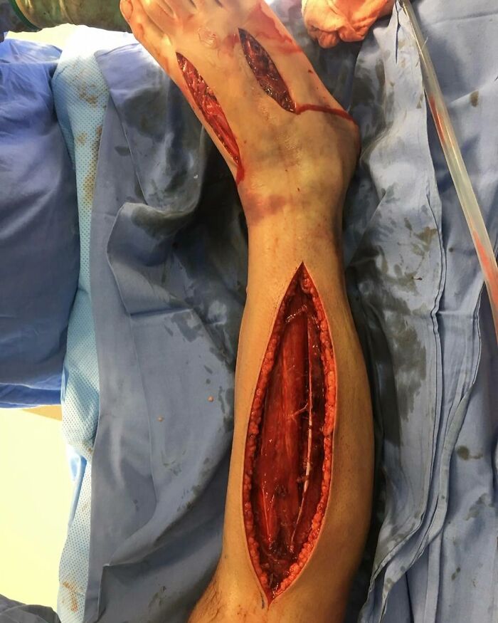 Snake Bite Leads to Compartment Syndrome—Serious Stuff