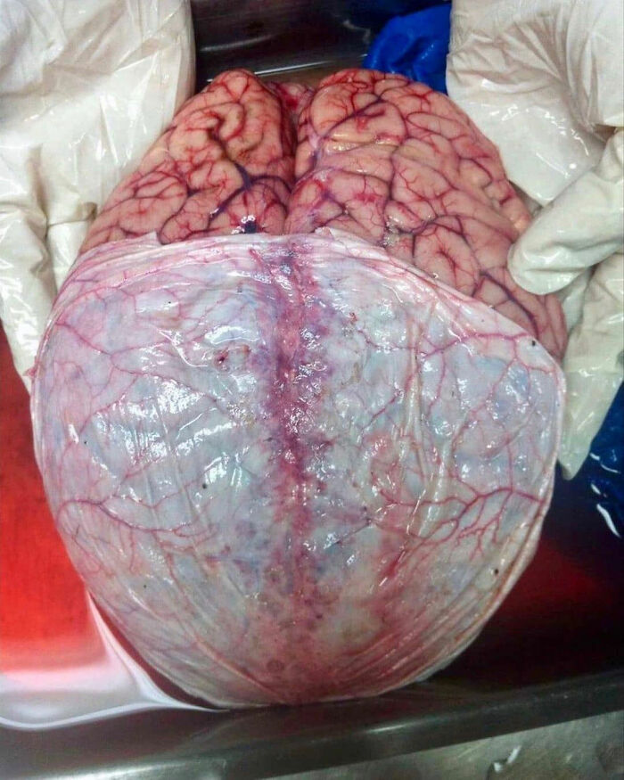 The Brain with its Protective Layers—Meet the Meninges