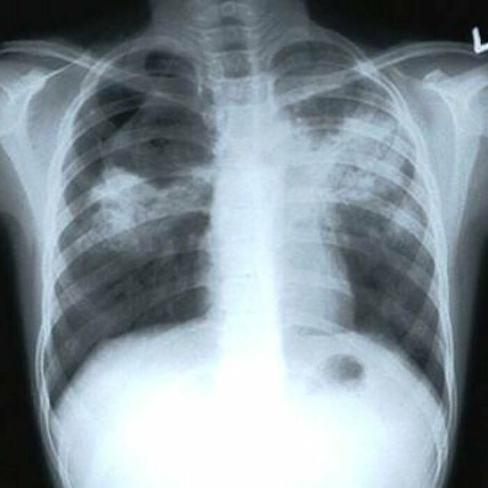 Pulmonary TB: Lung Scars and Cavities Wrapped Up in One Picture