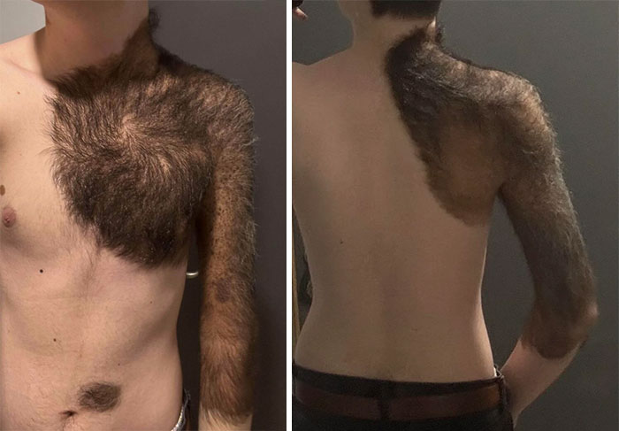 I Was Born With A Giant Birthmark That Definitely Stands Out