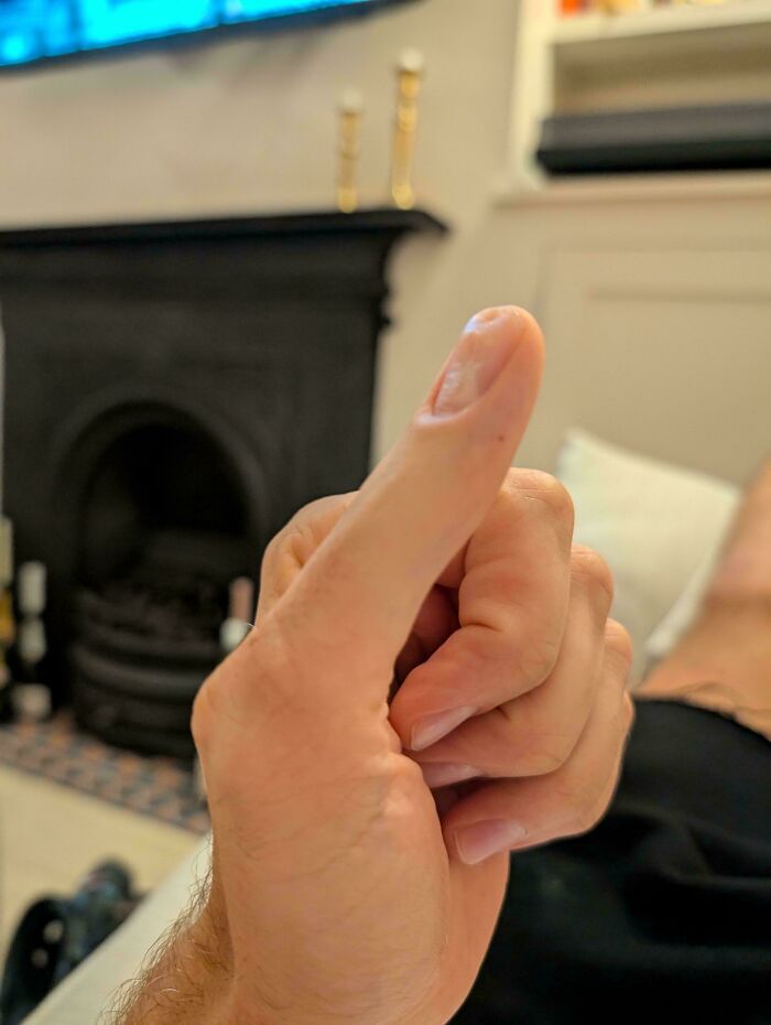 No Second Joint In My Thumbs Or Toes. Weird?